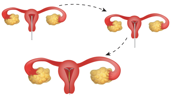 iud-process